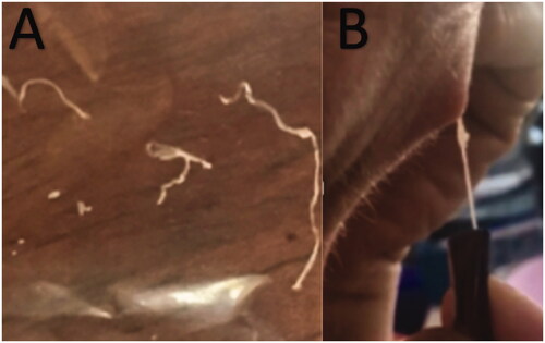 Figure 4. Images (A, B) showing fragments of the Dirofilaria nematode being removed from the erupted nodule.
