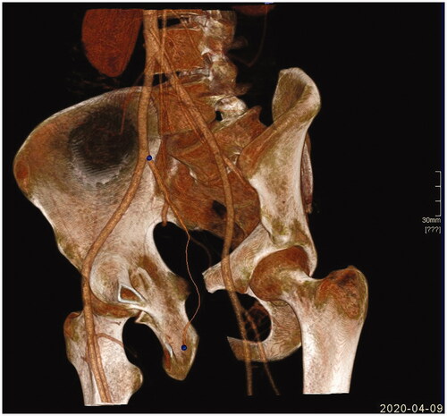 Figure 2. 3D colour image of highlighted (line marked) passage of IPA from its offspring from the internal iliac artery to the final bifurcation at the root of the penis.