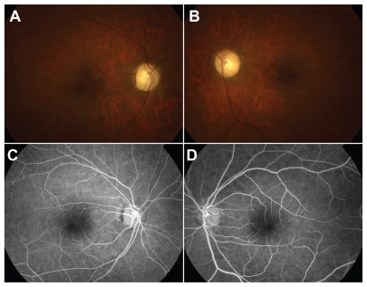 Figure 3 Color fundoscopic images of right a) and left b) eyes 28 months postingestion showing attenuated retinal vessels and optic nerve pallor. FA of the right c) and left d) eyes reveals attenuated vessels without evidence of perfusion deficits.