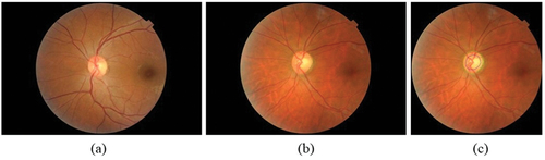 Figure 1. Fundus image (a) healthy eye (b) glaucomatous eye (c) glaucomatous image marked by the expert.