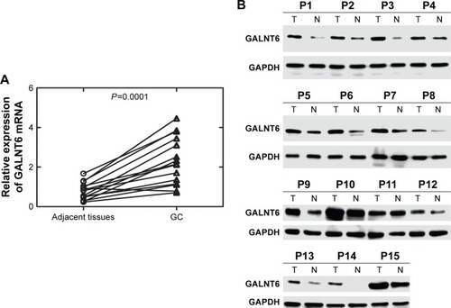 Figure 1 Expression levels of GALNT6 mRNA and protein in GC.