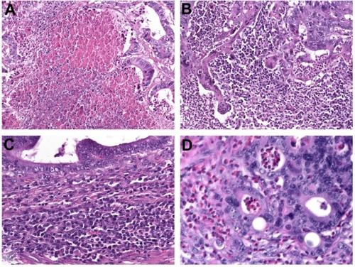 Figure 3 (A–D) Additional prognostic variables in colorectal cancer. (A) Coagulative tumor necrosis reflecting chronic ischemic injury due to rapid tumor growth. Assessing the anti-tumoral inflammatory response is another novel prognostic tool which commonly indicates favorable outcome. (B) Marked overall inflammation at the tumor margin, characterized by a mixed inflammatory infiltrate with destruction of cancer-cell islets. (C) Antitumor immune response, characterized by dense peritumoral lymphocytic infiltration; (D) Eosinophilic infiltration of the tumor area (tumor-associated tissue eosinophilia).