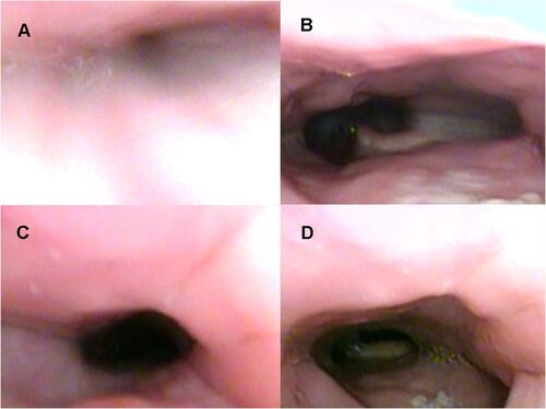 Figure 3 Drug-induced sleep endoscopy findings at the velar level: supine position. No intermittent negative airway pressure (iNAP) therapy during (A) inspiration and (B) expiration. Application of iNAP therapy during (C) inspiration and (D) expiration.