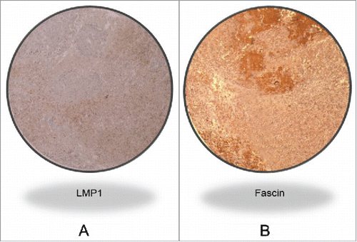 Figure 1A. Representative IHC case revealing LMP1 and Fascin co-expression in a high grade invasive CRC cancer tissue sample. Magnification value is 40X. This analysis was performed using TMA methodology; and the presence of EBV was confirmed by PCR using specific primers for LMP1 and EBNA1 genes in all our samples with all the necessary controls, as described in the Materials and Methods section.