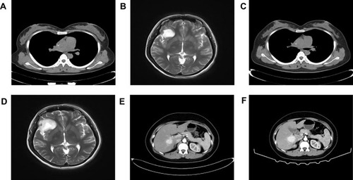 Figure 2 Computed tomography of the chest and breast before treatment. (A) First whole body assessment. Abnormal high-density shadows can be seen on magnetic resonance imaging of the head. (B) Computed tomography before modified radical mastectomy of left breast cancer. (C) Magnetic resonance imaging of the second intracranial mass before surgery. (D) First computed tomography image revealing the hepatic space-occupying lesions. (E) Computed tomography image of the hepatic mass before biopsy (F).