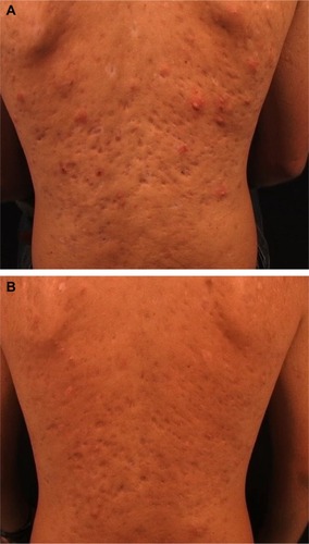 Figure 5 Severe atrophic acne scars on the back of a young man before (A) and 6 months after one ablative fractionated carbon dioxide (CO2) laser treatment (B).
