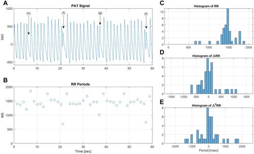 Figure 4 Premature beats. The PAT signal (A) and the derived RR periods (B) in a window of 60 seconds. The premature beats are associated with shorter RR periods compared to the surrounding beats (B). This leads to sparse histograms with isolated bins (C). As the density of premature beats increases, a pattern of multimodal distribution emerges (D and E). (A) Premature might produce lower amplitudes in the PAT signal, as in the beats marked (f). In some cases, the amplitude is unchanged (g), and in other cases, the pulse is hardly observable (h).