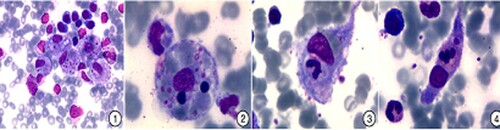 Figure 2. Morphological characteristics of hemophagocytes. (1) Focal distribution of hemophagocytes; (2) The hemophagocytes are round, which phagocytose red blood cells, lymphocytes and platelets; (3) The hemophagocytes are tadpole-like, which phagocytose red blood cells, neutrophilic stab granulocyte and platelets; and (4) The hemophagocytes are spindle-shaped, which phagocytose neutrophilic segmented granulocytes. Figure adapted from Ref. [Citation44].