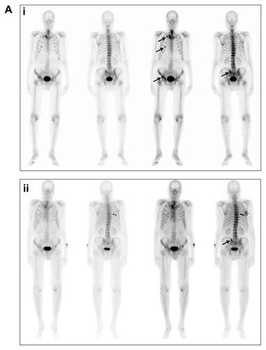 Figure 2A Bone scans from patient 1, taken in (i) September 2008 and (ii) June 2012.Notes: Arrows in both panels indicate sites of metastases; the asterisk in the lower panel indicates a site of trauma.