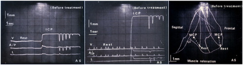 Figure 3. The three-dimensional jaw movement from rest position before treatment (left) and post muscle relaxation by TENS (middle). The mandible positioned approximately 0·6 mm anteriorly, 0·4 mm laterally, and 4·5 mm vertically from rest position after muscle relaxation. The position relationship between rest, MCP, and ICP after muscle relaxation by TENS is shown (right). ICP was located approximately 1 mm posterior to, 3·5 mm above, and 2 mm lateral to MCP.