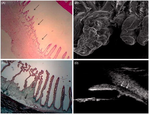Figure 4. (A) Photomicrographs showing an entire lesion, with coagulation necrosis, loss of the bilayered ciliary epithelium and distension of the stromal collagen fibres (black arrows, magnification ×40). (B) Scanning electron microscopy of a treated ciliary process (left) and an untreated ciliary process (right) (×1000). (C) Photomicrographs showing an entire lesion, with also a fluid space between the sclera and the choroid (black arrows, magnification ×50). (D) Ultrasound biomicroscopy of a human eye 1 month after treatment, showing a hypoechoic fluid space between the sclera and the choroid (white arrows).