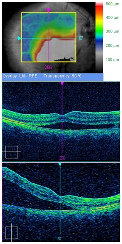 Figure 3 Optical Coherence Tomography Cirrus (Carl Zeiss Meditec, Dublin, CA, USA), macular thickness. It shows a huge neurosensory detachment from disc to macula in right eye.