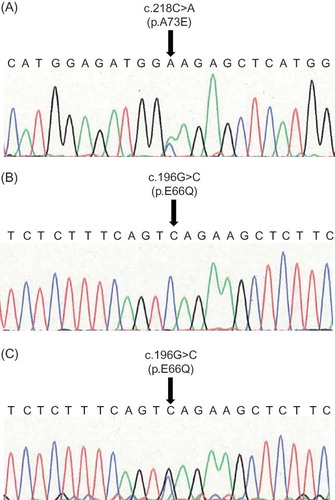 Figure 2. Direct nucleotide sequencing of PCR-amplified DNA from the α-Gal A gene. (A) Sense strand of the DNA from patient 1. Arrow indicates nucleotide 218, where a C>A transversion resulted in the amino acid substitution p.Ala73Glu. (B, C) Sense strands of the DNA from patient 2 (B) and patient 3 (C). Arrow indicates nucleotide 196, where a G>C transversion resulted in the amino acid substitution p.Glu66Gln.
