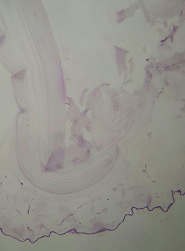 Figure 5 Histopathology microscopic section showing a laminated acellular cyst wall with nucleated germinal layer.