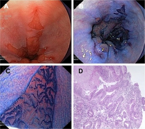 Figure 2 (A) Conventional endoscopic view of Barrett’s esophagus with concomitant esophagitis. (B) Positive staining of Barrett’s epithelium after absorption chromoendoscopy with methylene blue dye solution (1%, 10 mL). (C) Villous cerebroid pits with finger-like projections seen with magnification endoscopy (pattern 5 according to Endo’s classification). (D) Histological section of (C) showing intestinal metaplasia with glands of different size and shape and numerous goblet cells.