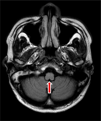 Figure 5 Magnetic resonance imaging of the brain showed atrophy of the brainstem (red arrow).