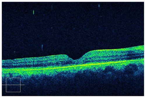 Figure 2 Postoperative OCT of traumatic macular hole with silicone oil tamponade after oil removal.