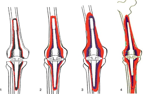 Figure 2. ENDO classification (Engelbrecht Citation1993) with regard to constrained knee prostheses: increasing loss of bone stock (colored red) from type 1 to type 4. Type-1 defects are minor bone defects with thin radiolucent lines but no subsidence of components. Type-2 defects involve moderate bone loss, evidenced by wider radiolucent lines around the entire implant and clear signs of subsidence. Depending on the model used, there may be thinning of the distal femoral or tibial proximal cortex or of the cancellous bone within the region of the femoral and tibial condyles. Type-3 defects are severe loss of bone with widening of the distal femur or proximal tibia, cortical thinning with perforations, and severe condylar defects. Type-4 defects are massive: there is total or severe loss of bone stock. More than half of the femur is defective, or the remains of the middle or proximal parts are weakened by severe cortical thinning or severe osteoporosis from lack of use.