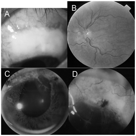 Figure 3 Case 3 had a giant ischemic bleb (A) and hypotony after MMC trabeculectomy. His left fundus showed typical hypotony maculopathy (B). After corneal lamellar grafting, the anterior chamber had remained deep (C) and the IOP had increased because of complete closure of the scleral cleft (D).