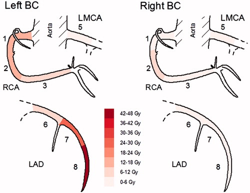 Figure 1. Segment-wise distribution of mean maximal radiation doses, of seven left- and eight right-sided women with breast cancer (BC). Gy: Gray; LMCA: left main coronary artery; LAD: left anterior descending artery; RCA: right coronary artery.