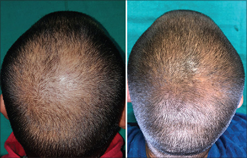 Figure 2 Before and after of a patient with AGA treated with PRP and microneedling. Reproduced from Aggarwal K, Gupta S, Jangra RS, Mahendra A, Yadav A, Sharma A. Dermoscopic assessment of microneedling alone versus microneedling with platelet-rich plasma in cases of male pattern alopecia: a split-head comparative study. Int J Trichol. 2020;12(4): 156, under the Creative Commons Attribution-Non Commercial-ShareAlike 4.0 License.Citation106