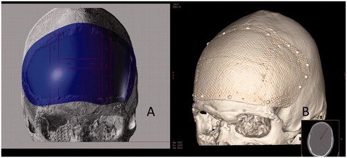 Figure 7. Computer aided design of patient specific FRC-BG implant for reconstructing the defect area (A) and computer tomography reconstruction (B) of the FRC-BG implant after cranioplasty operation (Courtesy by Professor Willy Serlo, Oulu University Hospital, Finland).