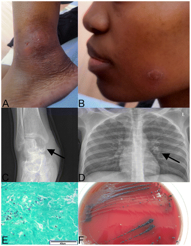 Figure 1: A: Swollen, fluctuant left ankle with sinus formation. B: Well-circumscribed, scaling plaque on the patients face that resolved after treatment with amphotericin B and fluconazole. C: Lytic lesion in the patient’s right talus (arrow), consistent with osteomyelitis. D: Chest X-ray showing a small infiltrate in the left hilar region (arrow). E: Grocott’s stain (40x) showing fibrous connective tissue from the patient’s knee with variable sized fungal elements. F: Aureobasidium pullulans culture on blood agar from blood culture. Colonies were initially small and white, becoming black two weeks later.