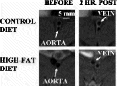 Figure 1. T1-weighted black-blood images of aortas from rabbits fed high-cholesterol or control diets before and 2 hrs. after αvβ3-targeted nanoparticle injection.