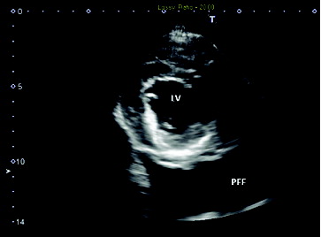 Figure 3. Ultrasonographic image of the heart: right parasternal transverse image of the heart revealed a normal image of the left ventricle (LV) with a large amount of slightly echogenic pleural free fluid (PFF).