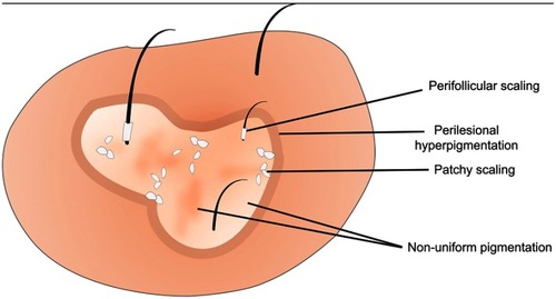 Figure 1 Illustration depicting dermoscopic features of a typical hypopigmented lesion of pityriasis versicolor.