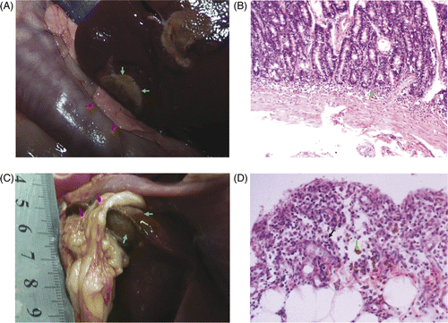 Figure 6. (A) Gross examination showed the colour of the bowel walls and pancreas (red) abutting the ablated liver (green arrow) were not changed obviously in group C within one hour of microwave ablation. (B) Histological examinations showed inflammatory cell infiltration (green arrow) in mucosa of small intestine wall (HE × 200). (C) On day 28 after microwave ablation, the surface of the ablated liver (green arrow) was brown and the edges were covered with omenta (red arrow). (D) On day 28 after microwave ablation, histological examination showed inflammatory reaction in omentum, including inflammatory cells (black arrow), and macrophages containing haemosiderin (green arrow) (HE × 200).