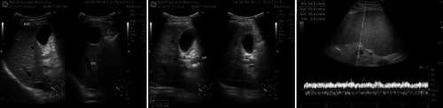 Figure 1 Abdominal Doppler ultrasonography with ascites, dilatation of portal vein, and low portal vein peak velocity.