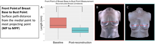 Figure 3. The front point of breast base to bust point measurement (medial point to most projecting point) significantly decreased in the reconstructed breast after unilateral implant-based reconstruction (p = 0.02). (A) Boxplot of the front point of breast base to bust point measurement at baseline and post-reconstruction (median and interquartile range). (B) The front point of breast base to bust point measurement on an exemplar patient at baseline. (C) The front point of breast base to bust point measurement on the same patient post-reconstruction.