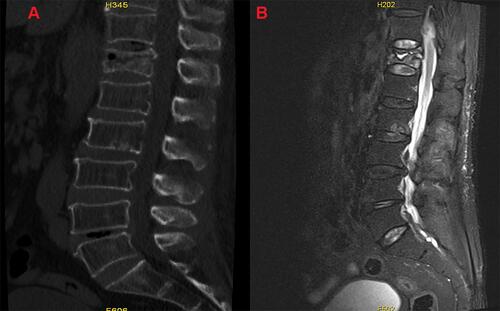 Figure 2 (A) Preoperative CT showed collapsed vertebral body and fractures in the vertebral body; (B) preoperative MRI showed collapsed vertebral body and fractures in the vertebral body.