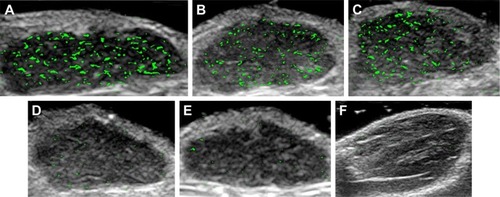 Figure 8 Transverse color-coded US images with (A) DNCs, (B) VNCs, (C) PNCs, (D)CNCs, (E) NNCs and in (F) the hind limb adductor muscle of mice using 22-MHz probe of MCF-7 orthotopic tumor from nude mice.Notes: CNCs, free antibodies pre-treated before DNCs application; DNCs, dual-targeted gold nanoshelled poly(lactic-co-glycolic acid) nanocapsules carrying anti-vascular endothelial growth factor receptor type 2 antibody and anti-p53 antibody; NNCs, non-targeted gold nanoshelled poly(lactic-co-glycolic acid) nanocapsules; PNCs, single-targeted gold nanoshelled poly(lactic-co-glycolic acid) nanocapsules carrying anti-p53 antibody; VNCs, single-targeted gold nanoshelled poly(lactic-co-glycolic acid) nanocapsules carrying anti-vascular endothelial growth factor receptor type 2 antibody.