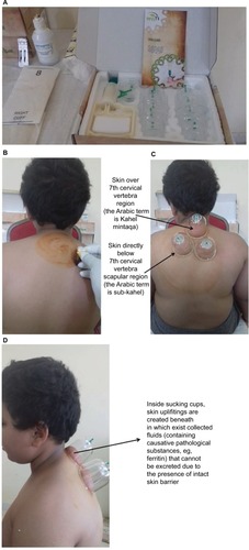 Figure 1 Preparation for performing Al-hijamah (wet cupping therapy of prophetic medicine).