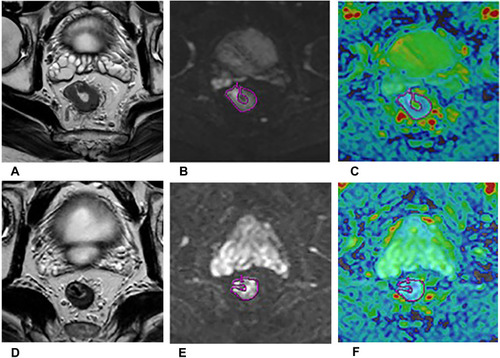 Figure 3 A 55-year-old man with LARC who achieved pCR after therapy. The oblique axial HR-T2WI (A and D), oblique axial DWI (b = 1000 s/mm2) (B and E), oblique axial ADC map (C and F) show the images of LARC before (A–C) and after (D–F) NAT. The mean ADC values were 0.87×10−3 mm2/s (C), 1.11×10−3mm2/s (F) respectively.