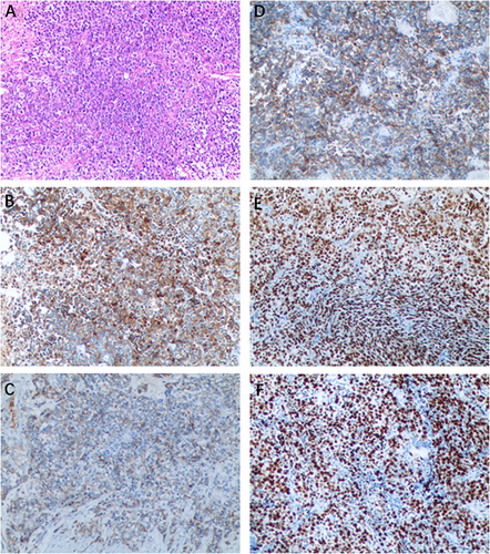 Figure 3 Histopathological and immunohistochemical staining of the tumor. (A) LCNEC of the bladder showed large cells with large nuclear size, prominent nucleoli, and abundant cytoplasm. (H&E staining, ×100). (B) The neoplasm displayed positive expression of Synaptophysin. (C) The neoplasm displayed positive expression of CgA. (D) Positive for CD56. (E) Positive for GATA3. (F) High proliferative index with Ki67 at 80%.