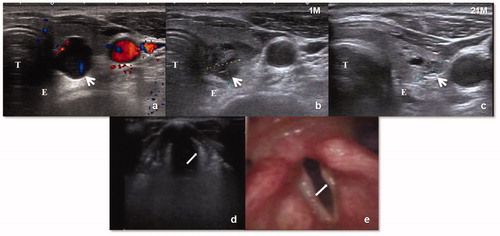 Figure 2. (a)Transverse US scan in a 69-year-old SHPT patient shows a parathyroid nodule (white arrow) behind inferior left lobe of thyroid abutting the trachea (T) and esophagus (E). (b–c) One and 21 months after MWA, US image shows the shrunken ablation zone(white arrow) clings to the area of the recurrent laryngeal nerve. (d–e) The left vocal cord (white arrow) loses tension, atrophies to be arched and becomes thin under eupnea on US. The left vocal cord is located on one side and could not close the glottis. Laryngoscopy revealed atrophic and thin left vocal cord.
