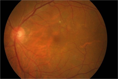 Figure 3 Color fundus photography without vitreous opacity after the secondary discharge.