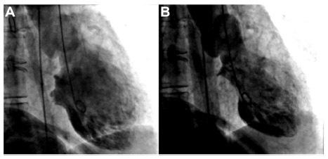 Figure 2 Left ventriculogram with apical ballooning during diastole (A) and systole (B).