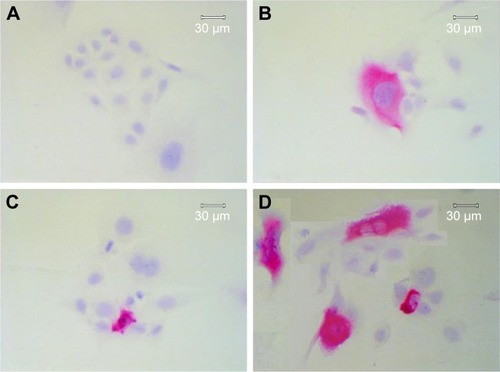 Figure 2 Immunohistochemical detection of apoptotic cells using M30 CytoDeath antibody in SCC9 and SCC25 cells. After 48 h, control SCC25 cells show only slight staining (A), whereas an enrichment of cytoskeletal staining is observed, together with a slight decrease in cell number, after treatment with 0.5 µmol/L cisplatin (B). Treatment with 100 µmol/L nimesulide alone (C) or in combination with 0.5 µmol/L cisplatin (D) reduced the SCC25 cell number and increased the number of apoptotic cells (clear enrichment of cytoskeletal staining). D contains a collage of apoptotic cells after incubation with nimesulide/cisplatin.