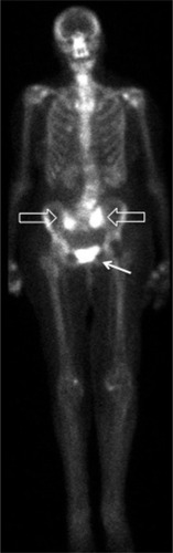 Figure 1 Bone scintigraphy showing increased sacral uptake bilaterally (hollow arrows) and pubic bone (solid arrow).