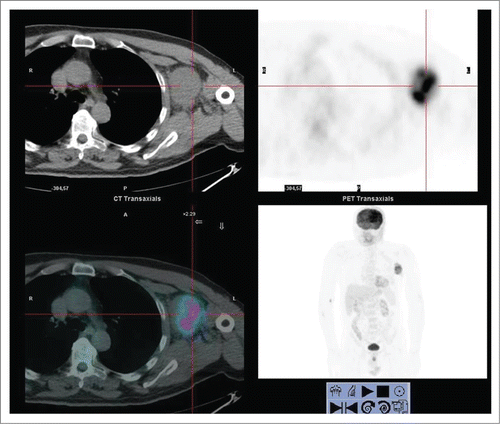Figure 1. Pre-surgical staging with total body 18 FDG- PET-CT showing a massive area of intense uptake in left axilla (SUV 13.5) without other localizations of disease.