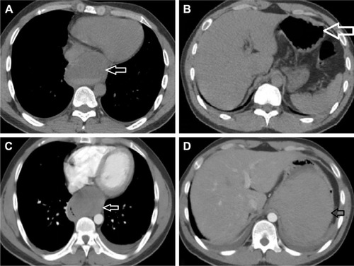 Figure 1 Preoperative imaging diagnoses. (A) Chest CT scan at the day before admission shows a smooth cystic tumor measuring 67 × 51 × 60 mm (white arrow). CT value was 28 HU. The esophagus was compressed by the cystic tumor. (B) An abdominal CT at the day before admission revealed a normal shape of the stomach (white arrow). (C) Transverse contrast-enhanced chest CT at 5 days after admission showed the sharply defined mass measuring 47 × 70 × 85 mm (white arrow). CT value was 31 HU. (D) Transverse contrast-enhanced abdominal CT at 5 days after admission showed a huge contusion of the stomach wall (black arrow).