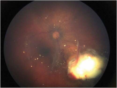 Figure 1. Small recurrent retinoblastoma that had measurable ctDNA in plasma.