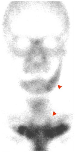 Figure 6 Bone scintigram 6 months after administration of antibiotics.