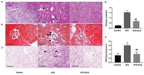 Figure 1 Pathological changes in the myocardial tissue of diabetic rats. Representative images showing cardiac tissue sections after hematoxylin and eosin (A), Masson’s trichrome (B), and periodic acid–Schiff staining (PAS, (C) (×200). Quantitative results for collagen accumulation assessed using Masson’s trichrome staining from images B (D) and extracellular matrix accumulation assessed using PAS staining for the different groups from images C (E), (original magnification 200x). The arrow in the cardiac tissue in the diabetic group of image A (middle), indicates that the structure of cardiac fibers was disturbed, nucleus disappeared or intercellular boundary is unclear. The arrows in the middle image of B and C show considerable deposition of collagen fibers or reactive glycogen respectively, inner bar=100 µm. Values are mean ± SE; n = 6 per group. **, p < 0.01 versus the control group and STZ+GLS group. ##, p < 0.01 versus the diabetic (STZ) group using Tukey’s test. Control: 5 mL/kg saline (p.o.); Diabetic: 50 mg/kg streptozotocin (i.p.) and 5 mL/kg saline (p.o.); STZ+GLS: 50 mg/kg streptozotocin (i.p.) and 300 mg/kg GLS (p.o.).