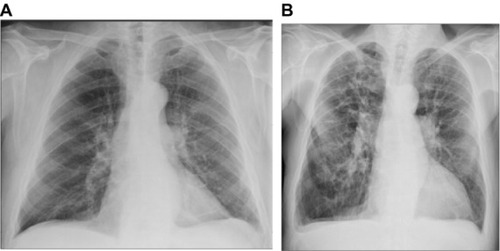 Figure 1 Randomly selected chest radiographs assessed negative in the routine assessment and positive in the standardized assessment.