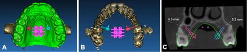 Figure 5 Positioning of virtual model of additional lateral bushings and miniscrews on the patient integrated model. (A) Occlusal view. (B) View from top, after isolating dental crowns and roots. (C) Coronal view with measurement of bone thickness at the level of additional lateral miniscrews.